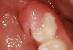 拔智齒 更新3 24 Kk130 S Blog 隨意窩xuite日誌