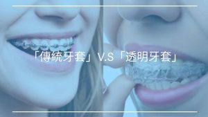 「透明牙套」與「傳統牙套」優缺點比較