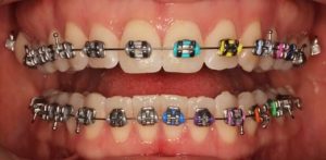 牙齒矯正器選擇之damon戴蒙矯正器知多少 快樂牙齒happy Teeth